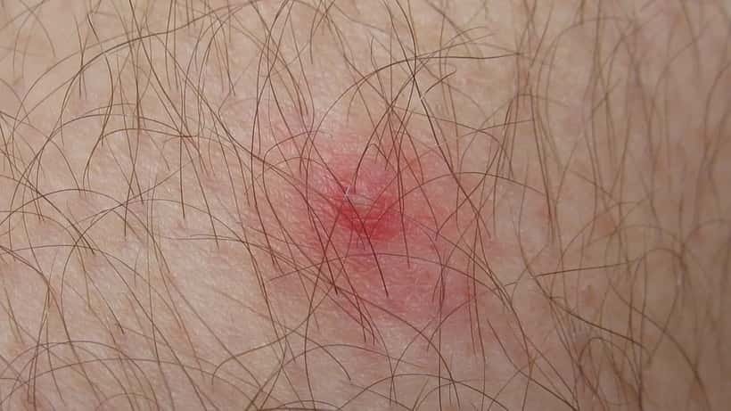 Site d'extraction d'une tique sur la peau humaine, illustration médicale