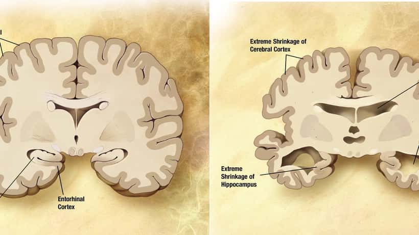 Vergelijking van hersenen met en zonder Alzheimer-aandoening